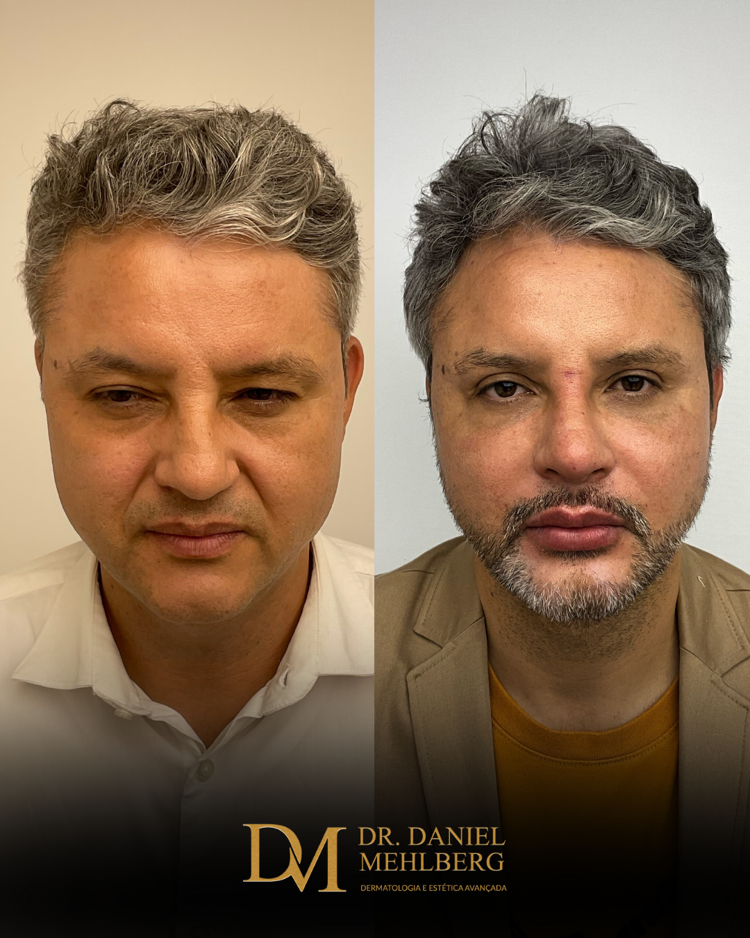 CASO H EDITADO 2